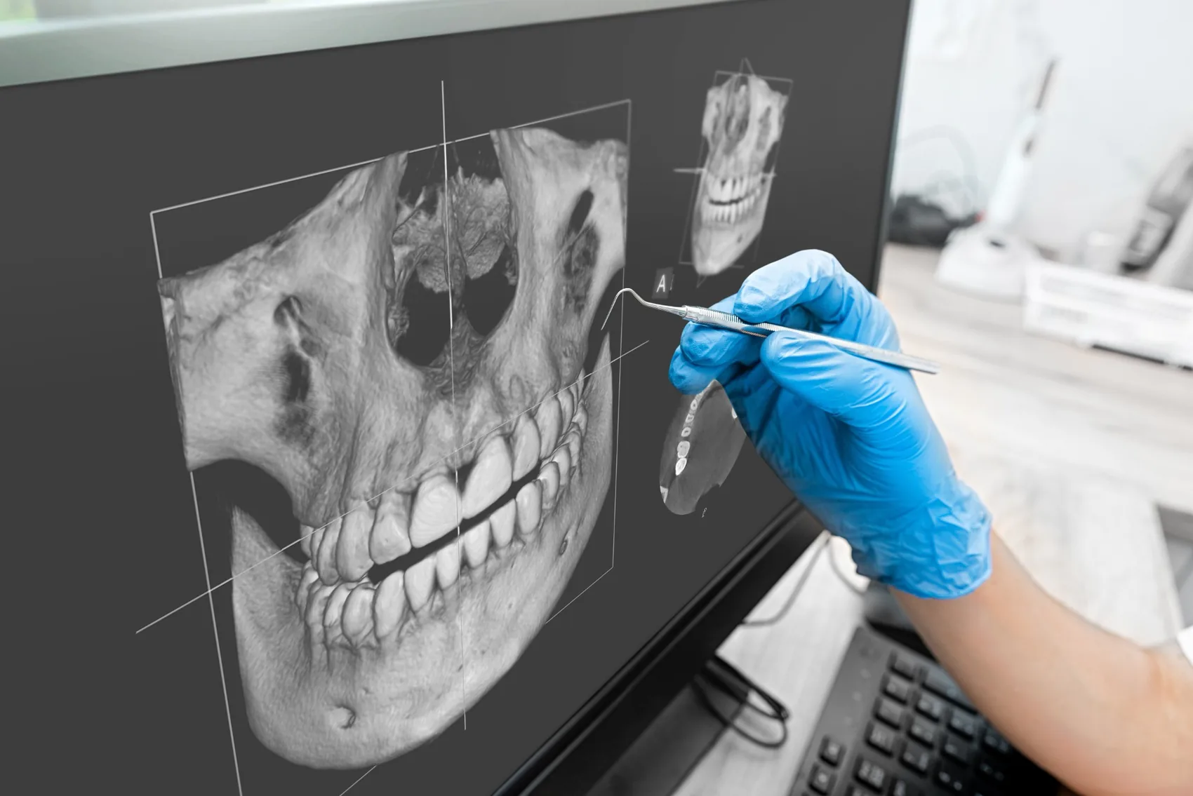 Tomografía dental CBCT